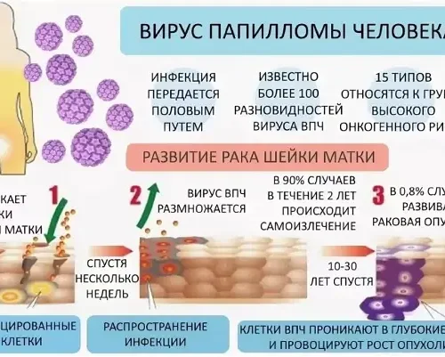virus_papilomi_cheloveka_u_genchin Вакциная от ВПЧ для профилактики рака шейки матки