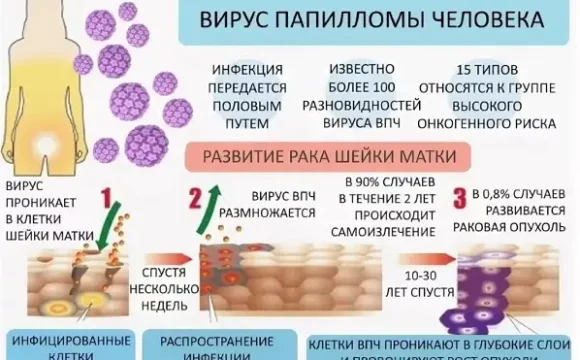 virus_papilomi_cheloveka_u_genchin Вакциная от ВПЧ для профилактики рака шейки матки
