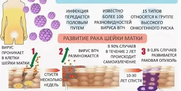 Вакциная от ВПЧ для профилактики рака шейки матки